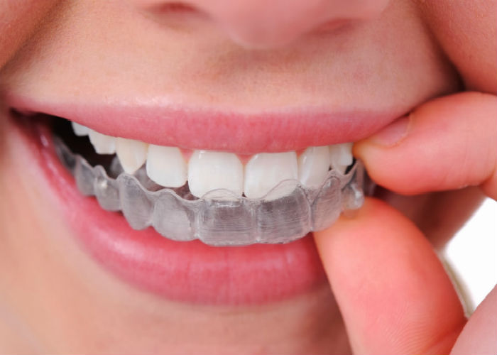 Invisalign: conheça essa novidade da ortodontia - Smart Odonto Betim